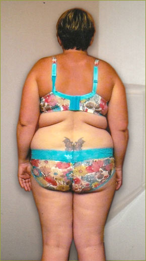 A picture of a woman before taking part of the HCG Serenity weight loss program - back picture