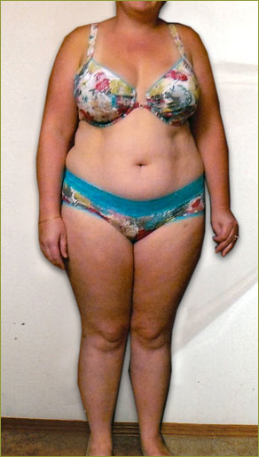 A picture of a woman before taking part of the HCG Serenity weight loss program - front picture