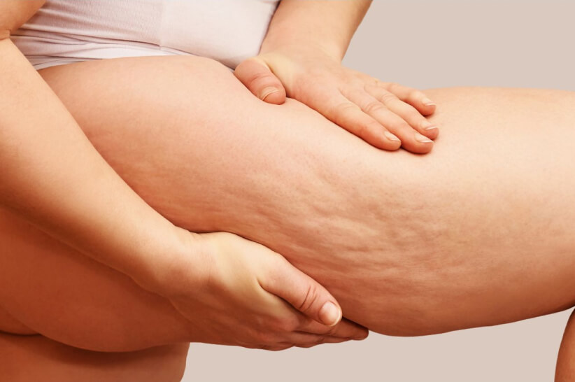 women leg showing Cellulite in her thigh