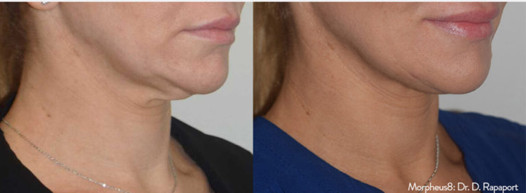 morpheus 8 before-and-after neck treatment