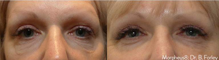 morpheus8-before-and-after eyes treatment