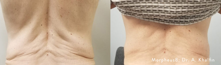 morpheus8-before-and-after-lower back skin