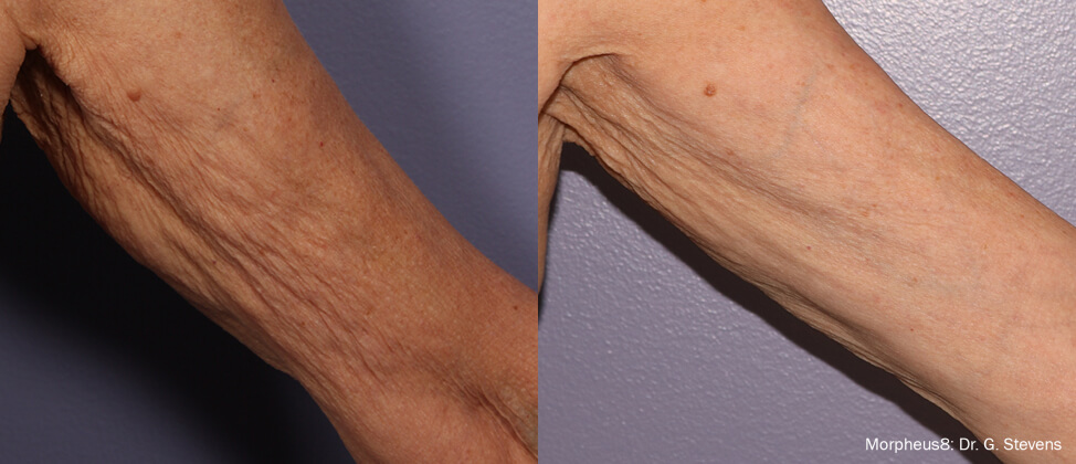 morphues8-before-after loose skin in the arm
