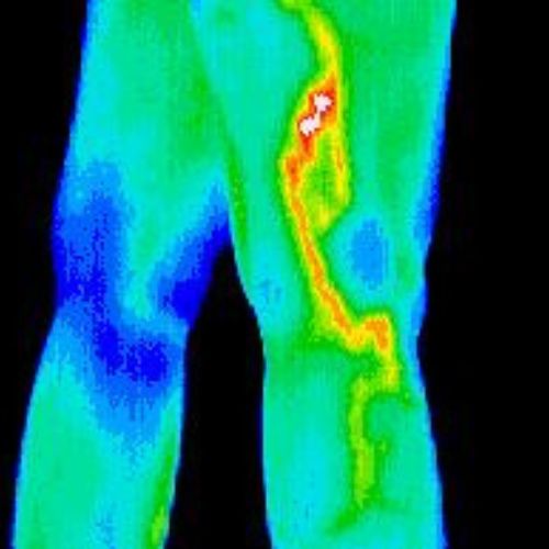 a thermogram of the right thigh. Serenity health care center for thermography