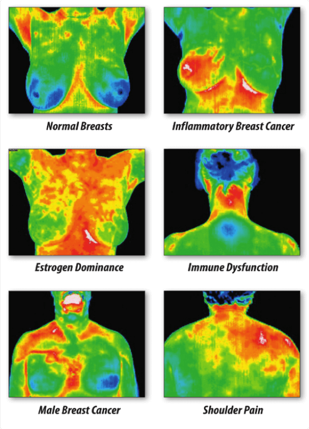 from top left a thermogram of normal breasts, followed by an inflammatory breast cancer, followed by estrogen dominance thermogram, followed by an Inmune dysfunction thermogram, followed by a photo of male breast cancer and n the bottom left a thermogram of shoulder pain. 